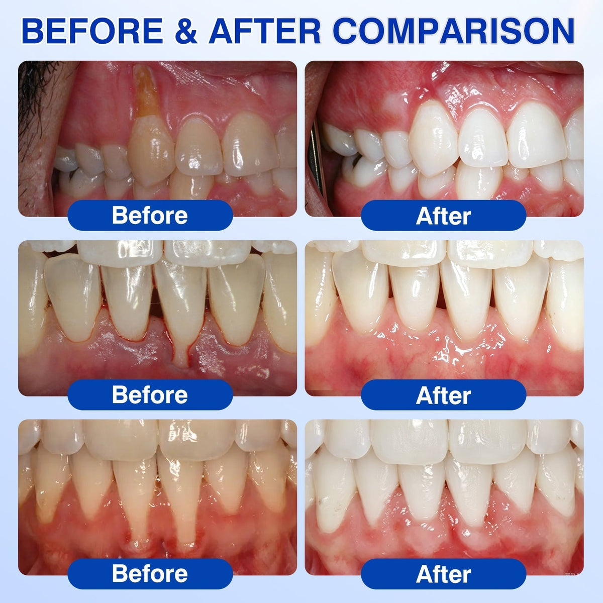 𝐇𝐈𝐒𝐊𝐈𝐍®👩‍⚕️🇬🇧🏅🦷🛡️ HISKIN® GumRevive Periodontal Repair Gel