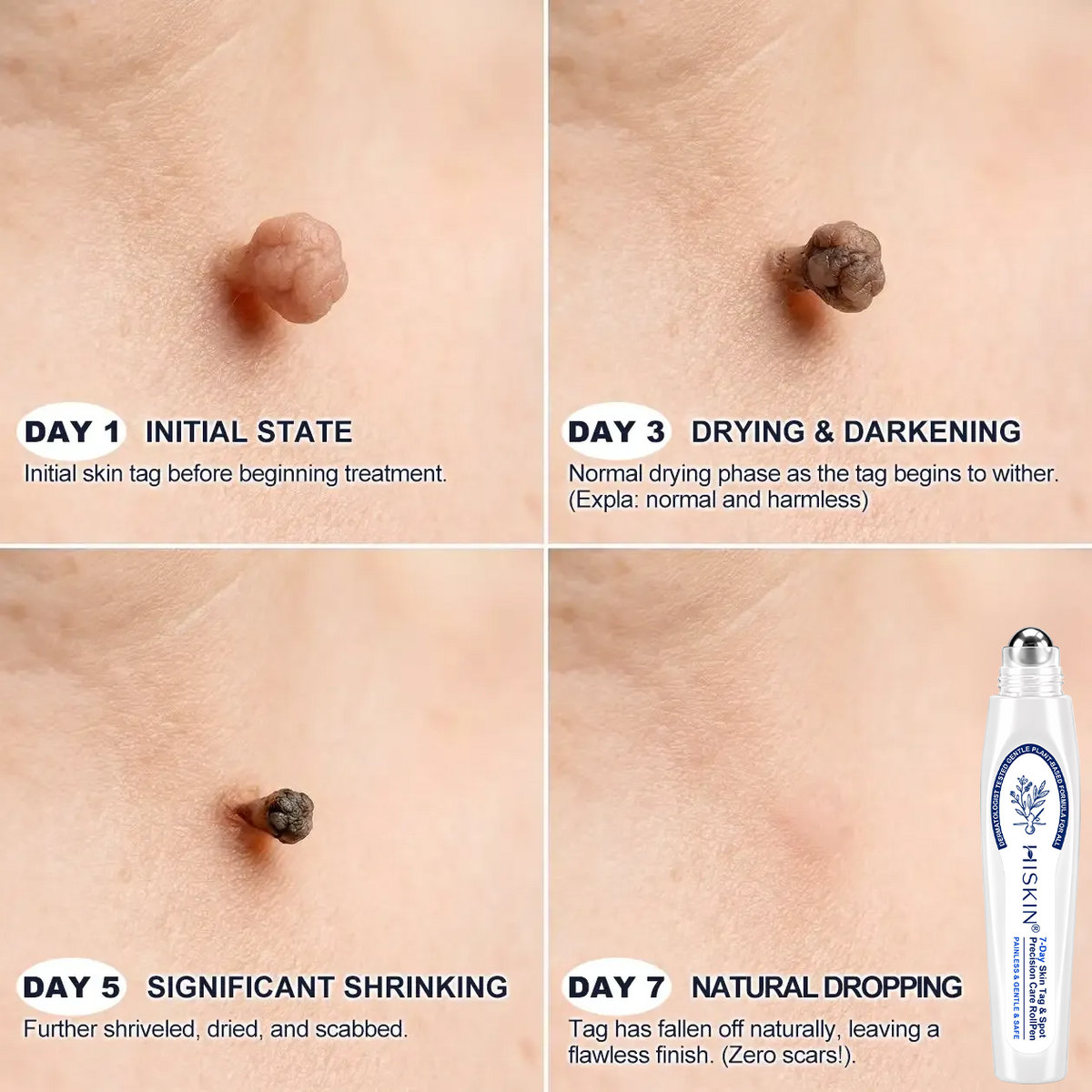 𝐇𝐈𝐒𝐊𝐈𝐍®👩‍⚕️ 𝟕-𝐃𝒂𝘆 𝐒𝗸𝐢𝐧 𝐓𝒂𝗴 & 𝐒𝐩𝙤𝐭 𝐄𝐫𝒂𝐬𝙚𝐫 Painless & Scar-Free Advanced Imperfection Removal Rollerball Pen